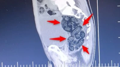 MİDESİNDE 64 PAR&Ccedil;A METAMFETAMİN TAŞIDI