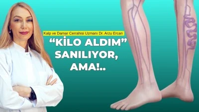 BACAKLARDA GE&Ccedil;MEYEN ŞİŞLİK VE AĞRIYA DİKKAT!
